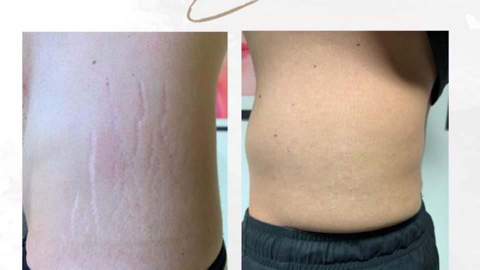 Camuflagem de estrias com Método Camuflatrix e resultado permanente
