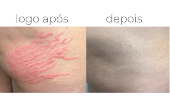 antes e depois tratamento de estruas