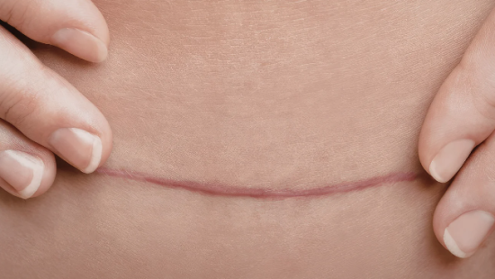cicatriz de abdominoplastia