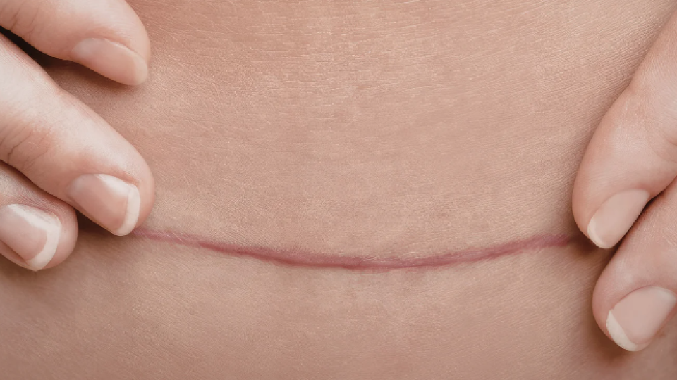 cicatriz de abdominoplastia